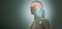 VNS Vagus nerve stimulation wikimedia